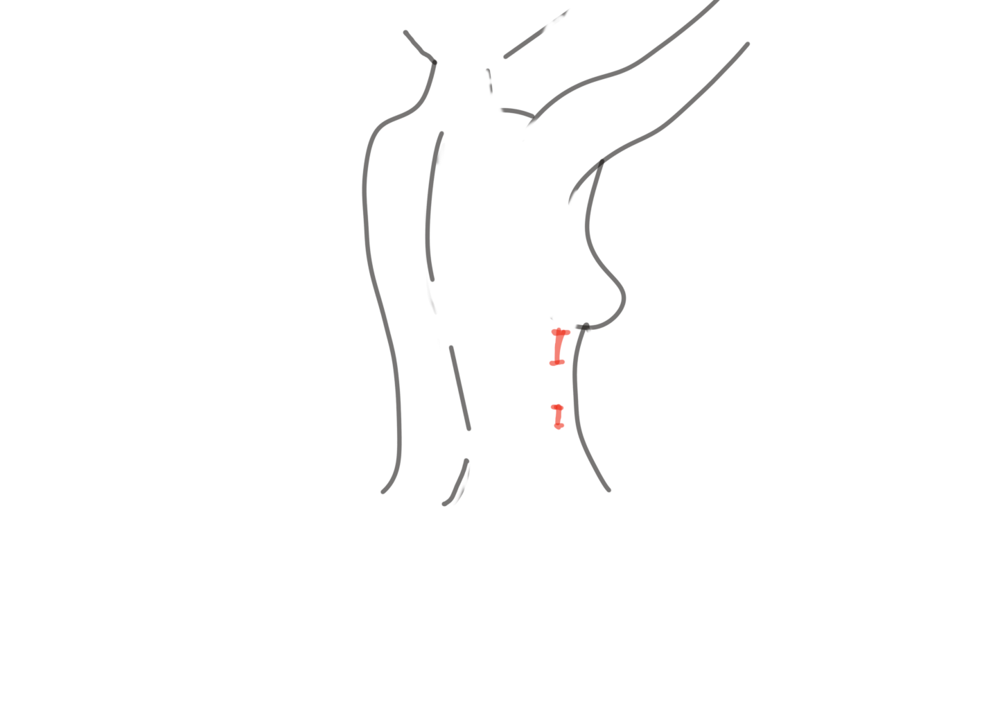 robotic assisted latissimus dorsi flap