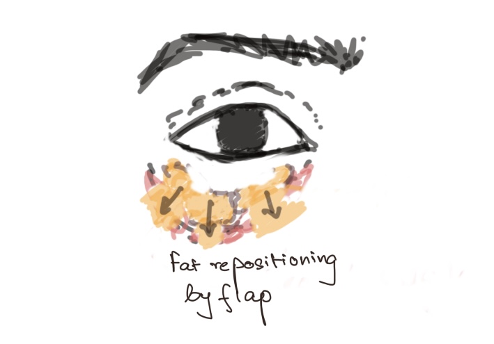 Blepharoplasty eye lid surgery fat grafting