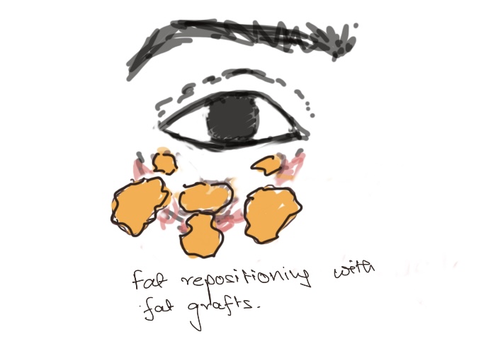 Blepharoplasty eyelid surgery fat grafting