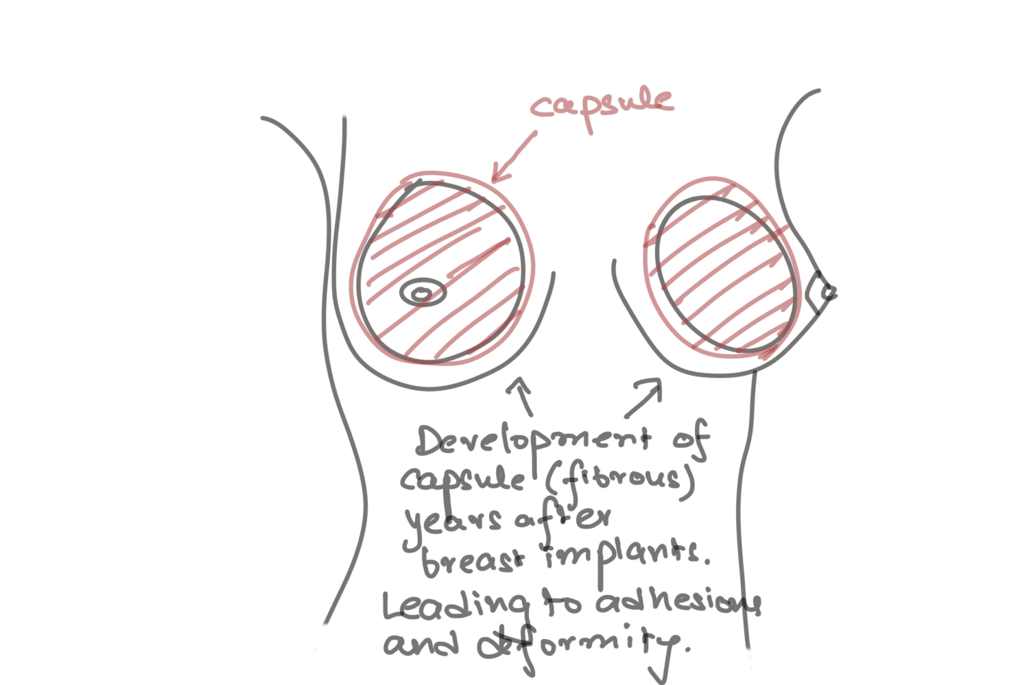breast implant contracture